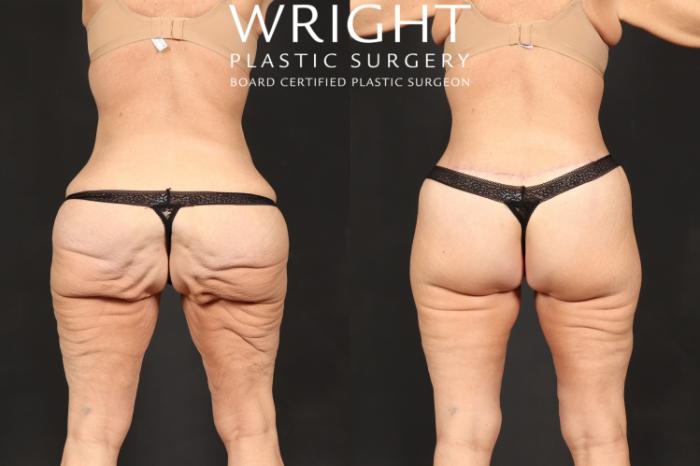 Before & After Body Lift Case 591 Back View in Little Rock, Arkansas