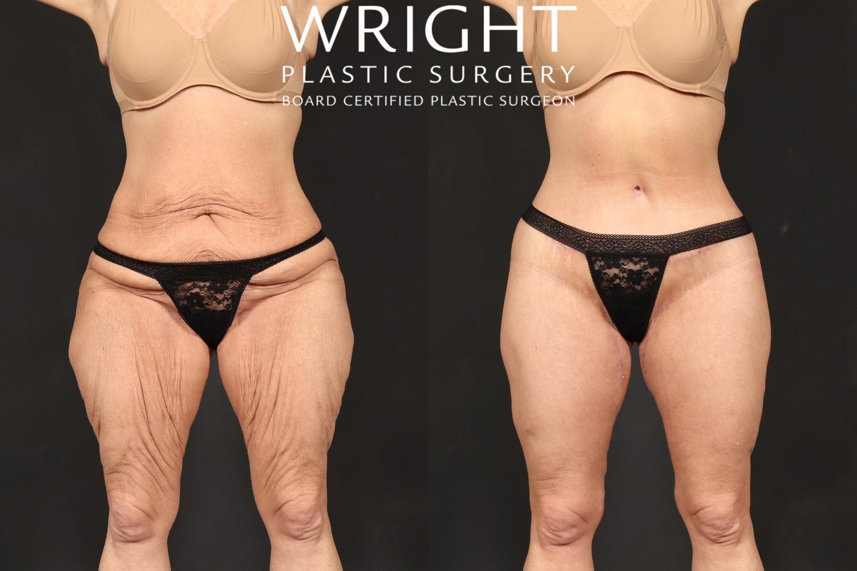 Before & After Body Lift Case 591 Front View in Little Rock, Arkansas