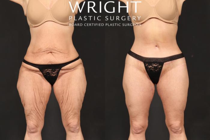 Before & After Body Lift Case 591 Front View in Little Rock, Arkansas