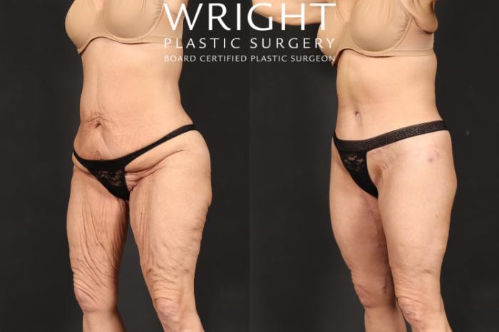Before & After Body Lift Case 591 Left Oblique View in Little Rock, Arkansas