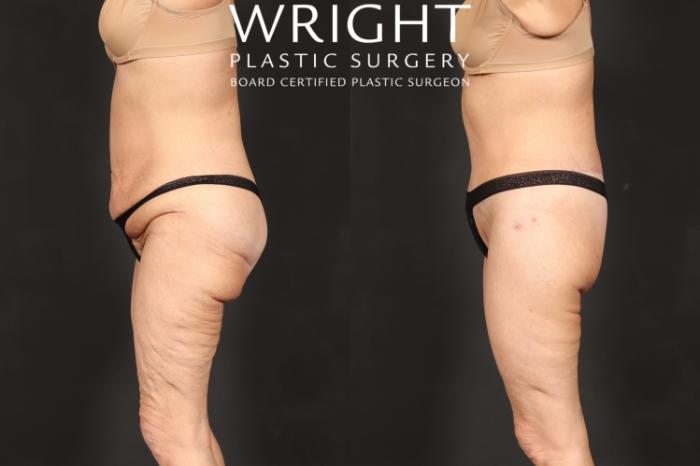 Before & After Body Lift Case 591 Left Side View in Little Rock, Arkansas
