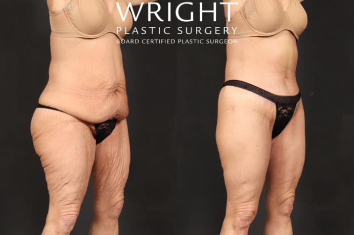 Before & After Body Lift Case 591 Right Oblique View in Little Rock, Arkansas