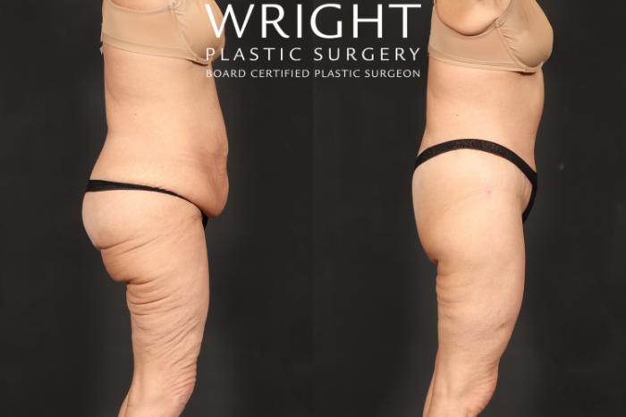 Before & After Body Lift Case 591 Right Side View in Little Rock, Arkansas
