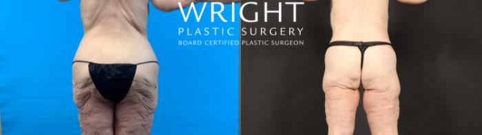 Before & After Body Lift Case 603 Back View in Little Rock, Arkansas