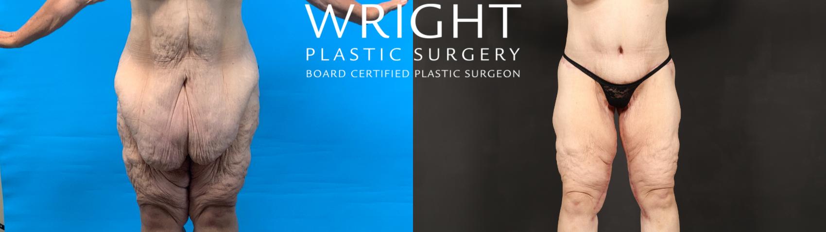 Before & After Body Lift Case 603 Front View in Little Rock, Arkansas