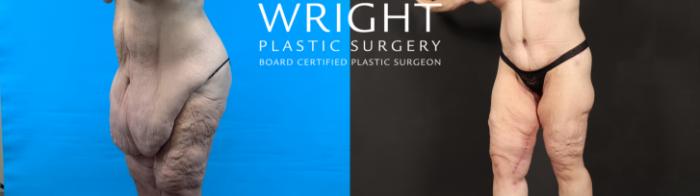 Before & After Body Lift Case 603 Left Oblique View in Little Rock, Arkansas