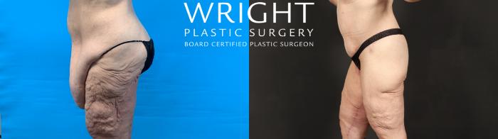 Before & After Body Lift Case 603 Left Side View in Little Rock, Arkansas