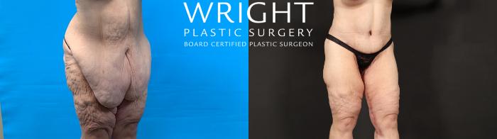 Before & After Body Lift Case 603 Right Oblique View in Little Rock, Arkansas