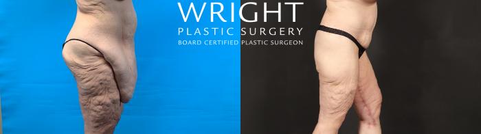 Before & After Body Lift Case 603 Right Side View in Little Rock, Arkansas