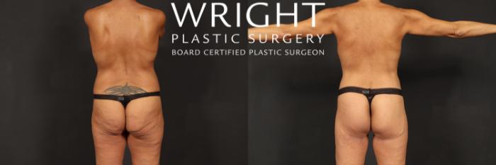 Before & After Tummy Tuck Case 604 Back View in Little Rock, Arkansas