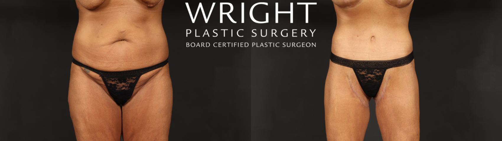 Before & After Tummy Tuck Case 604 Front View in Little Rock, Arkansas