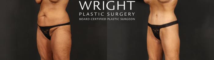 Before & After Tummy Tuck Case 604 Left Oblique View in Little Rock, Arkansas