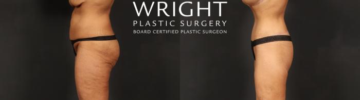 Before & After Tummy Tuck Case 604 Left Side View in Little Rock, Arkansas