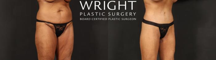 Before & After Tummy Tuck Case 604 Right Oblique View in Little Rock, Arkansas