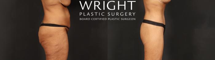 Before & After Tummy Tuck Case 604 Right Side View in Little Rock, Arkansas