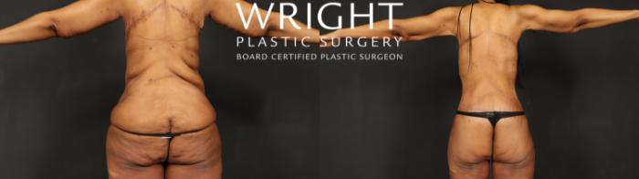 Before & After Body Lift Case 605 Back View in Little Rock, Arkansas