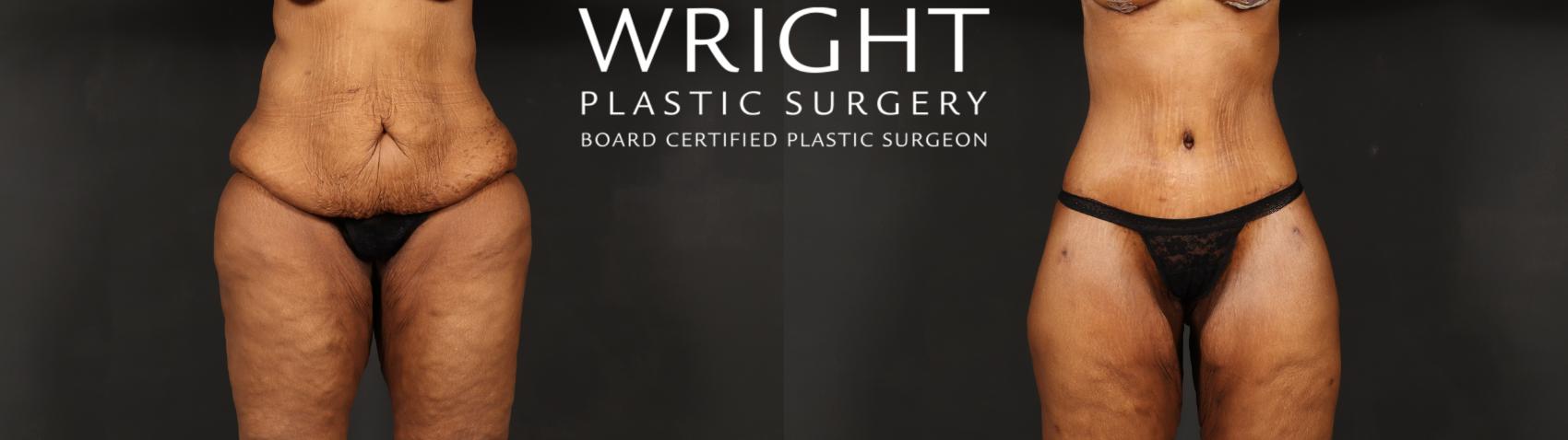 Before & After Body Lift Case 605 Front View in Little Rock, Arkansas