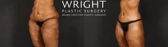 Before & After Body Lift Case 605 Left Oblique View in Little Rock, Arkansas