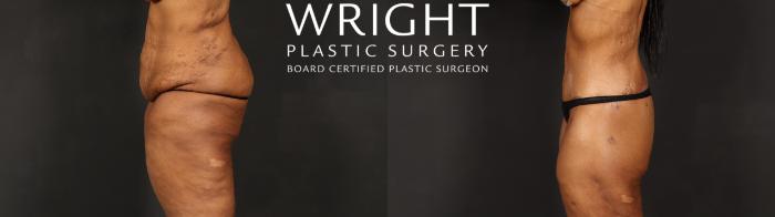 Before & After Body Lift Case 605 Left Side View in Little Rock, Arkansas