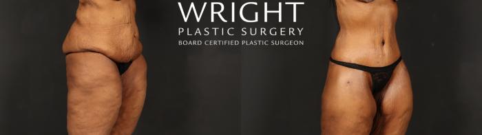 Before & After Body Lift Case 605 Right Oblique View in Little Rock, Arkansas