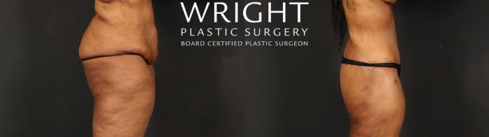 Before & After Body Lift Case 605 Right Side View in Little Rock, Arkansas