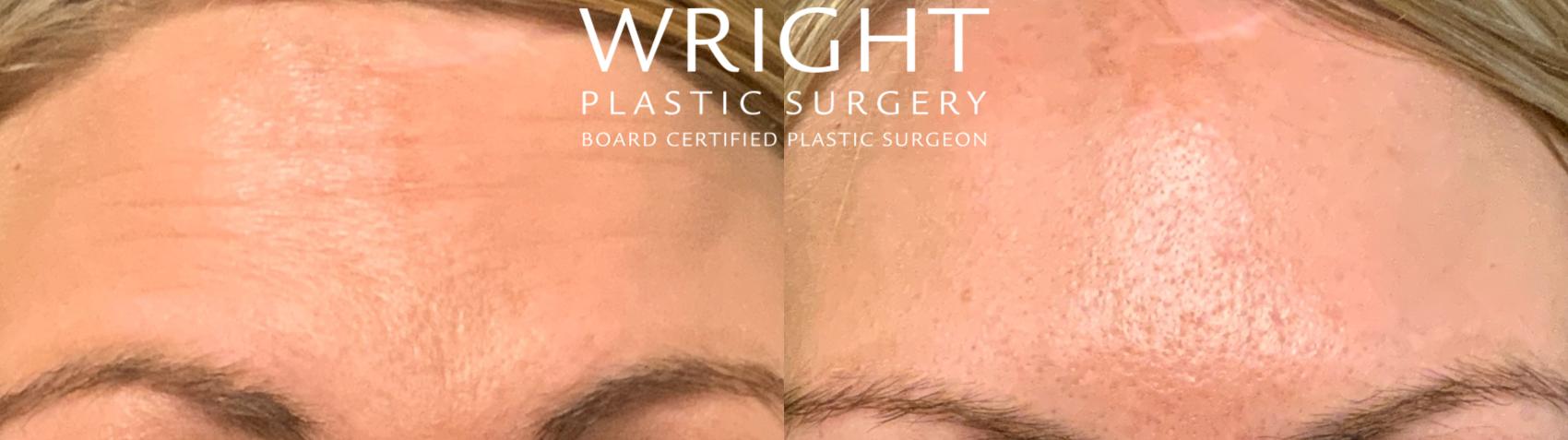 Before & After BOTOX® Cosmetic Case 100 Front View in Little Rock, Arkansas