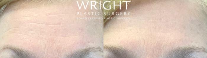 Before & After BOTOX® Cosmetic Case 53 Front View in Little Rock, Arkansas