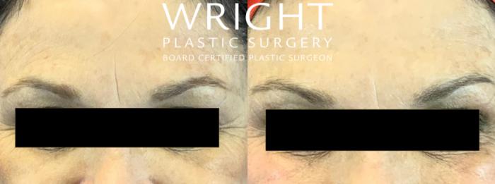 Before & After BOTOX® Cosmetic Case 54 Front View in Little Rock, Arkansas
