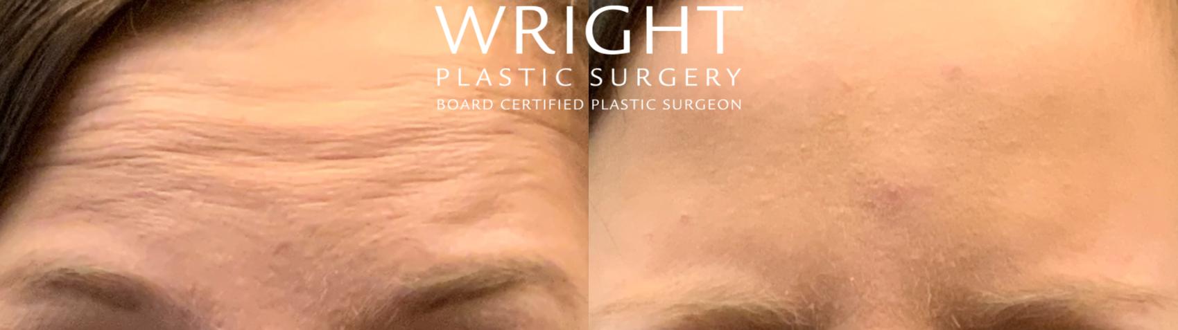 Before & After BOTOX® Cosmetic Case 74 Front View in Little Rock, Arkansas