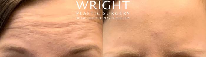 Before & After BOTOX® Cosmetic Case 74 Front View in Little Rock, Arkansas