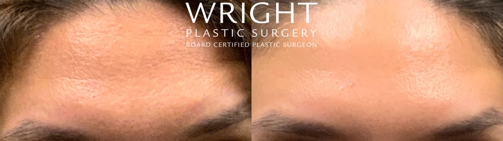 Before & After BOTOX® Cosmetic Case 95 Front View in Little Rock, Arkansas