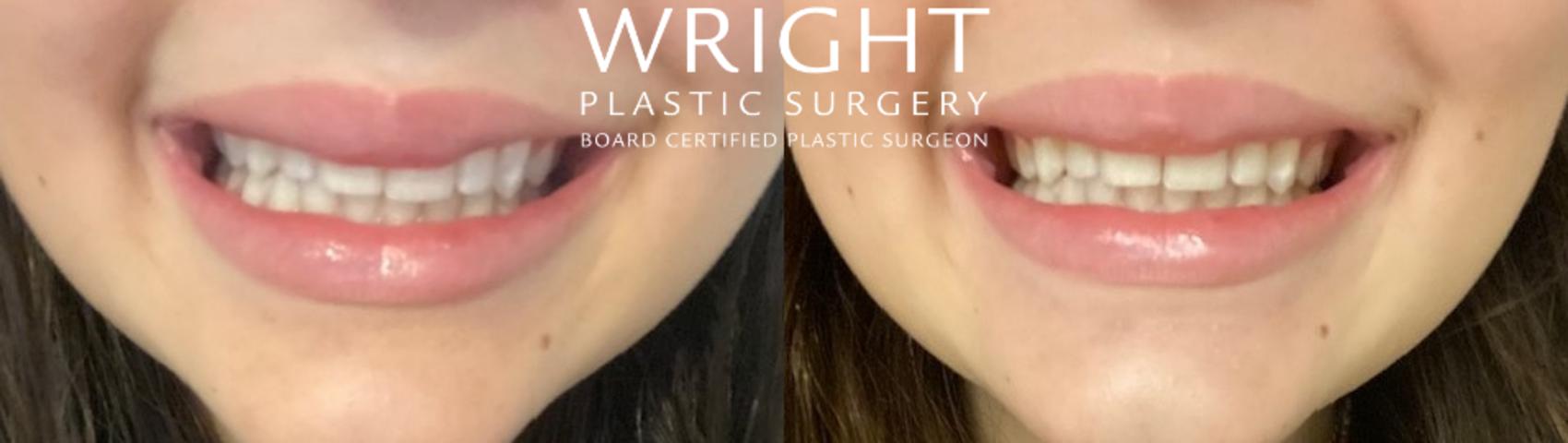 Before & After BOTOX® Cosmetic Case 98 Front View in Little Rock, Arkansas