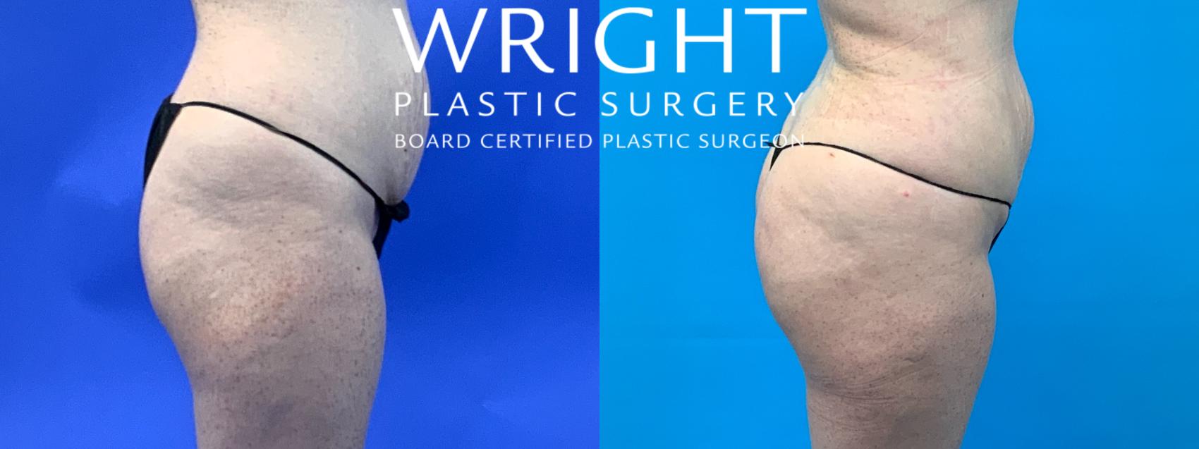 How to get certified in non-surgical butt lift (BBL) treatments