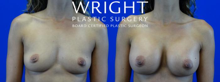 Before & After Breast Augmentation Case 1 Front View in Little Rock, Arkansas