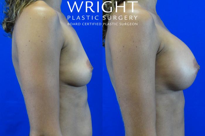Before & After Breast Augmentation Case 1 Right Side View in Little Rock, Arkansas