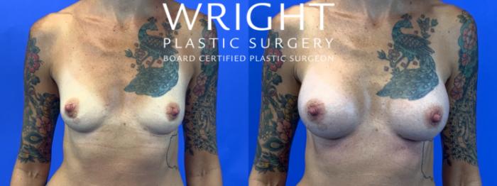 Before & After Breast Augmentation Case 102 Front View in Little Rock, Arkansas