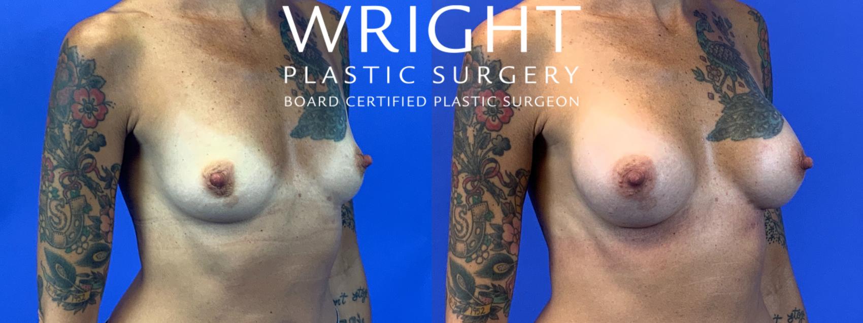 Before & After Breast Augmentation Case 102 Right Oblique View in Little Rock, Arkansas