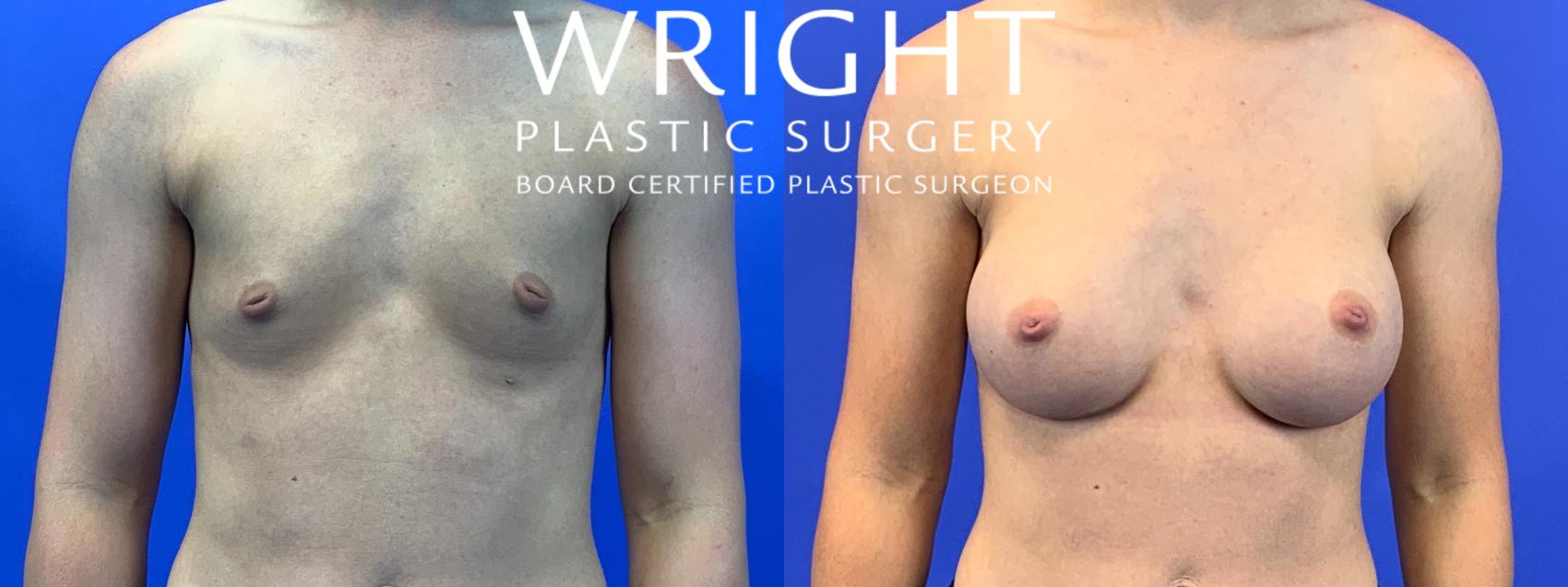 Before & After Breast Augmentation Case 103 Front View in Little Rock, Arkansas