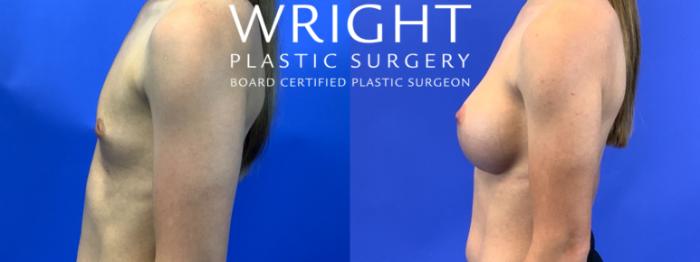 Before & After Breast Augmentation Case 103 Left Side View in Little Rock, Arkansas