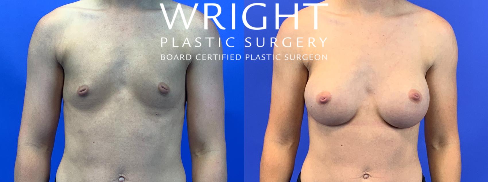 Before & After Breast Augmentation Case 104 Front View in Little Rock, Arkansas