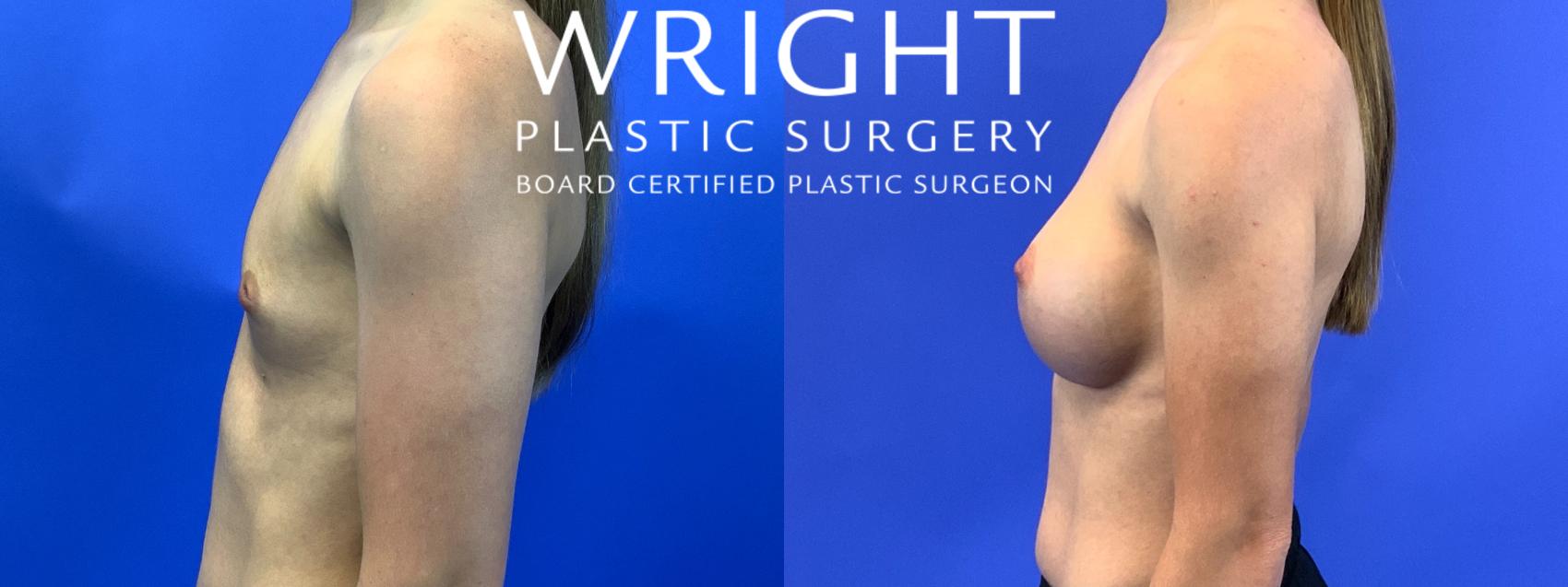 Before & After Breast Augmentation Case 104 Left Side View in Little Rock, Arkansas