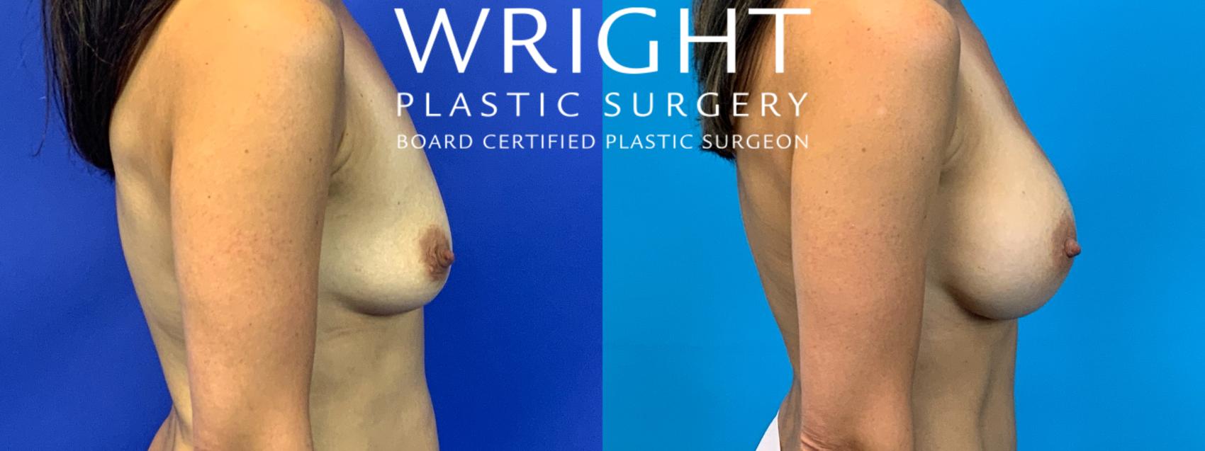 Before & After Breast Augmentation Case 105 Right Side View in Little Rock, Arkansas