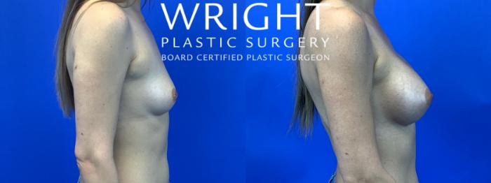 Before & After Breast Augmentation Case 106 Right Side View in Little Rock, Arkansas