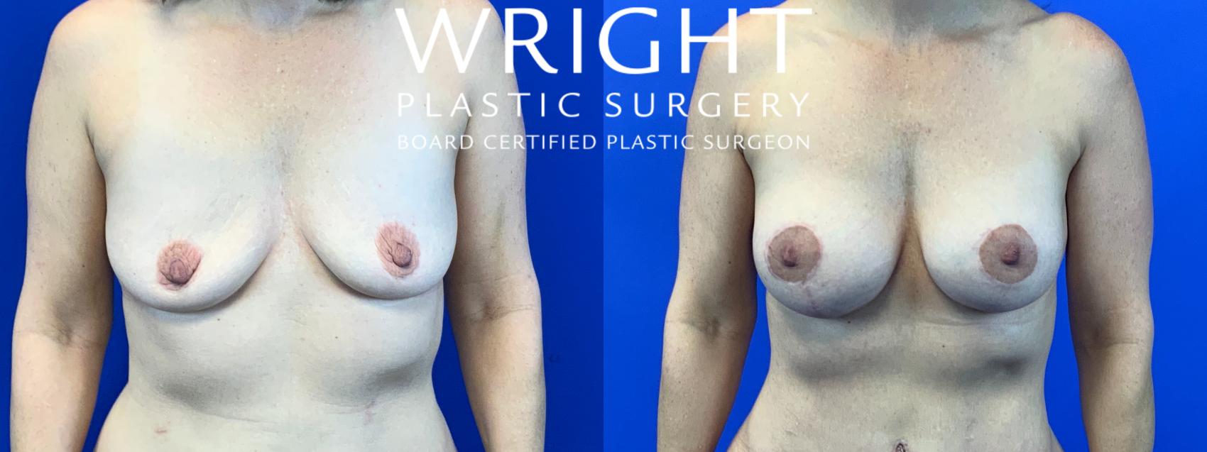 Before & After Breast Augmentation Case 131 Front View in Little Rock, Arkansas