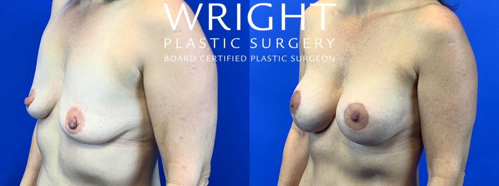 Before & After Breast Augmentation Case 131 Left Oblique View in Little Rock, Arkansas