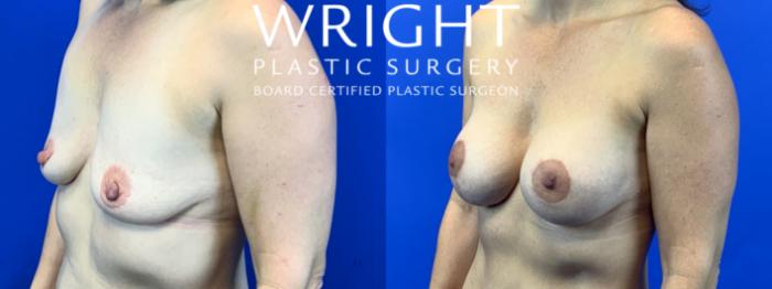 Before & After Breast Lift Case 131 Left Oblique View in Little Rock, Arkansas
