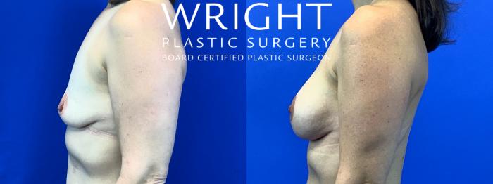 Before & After Breast Augmentation Case 131 Left Side View in Little Rock, Arkansas