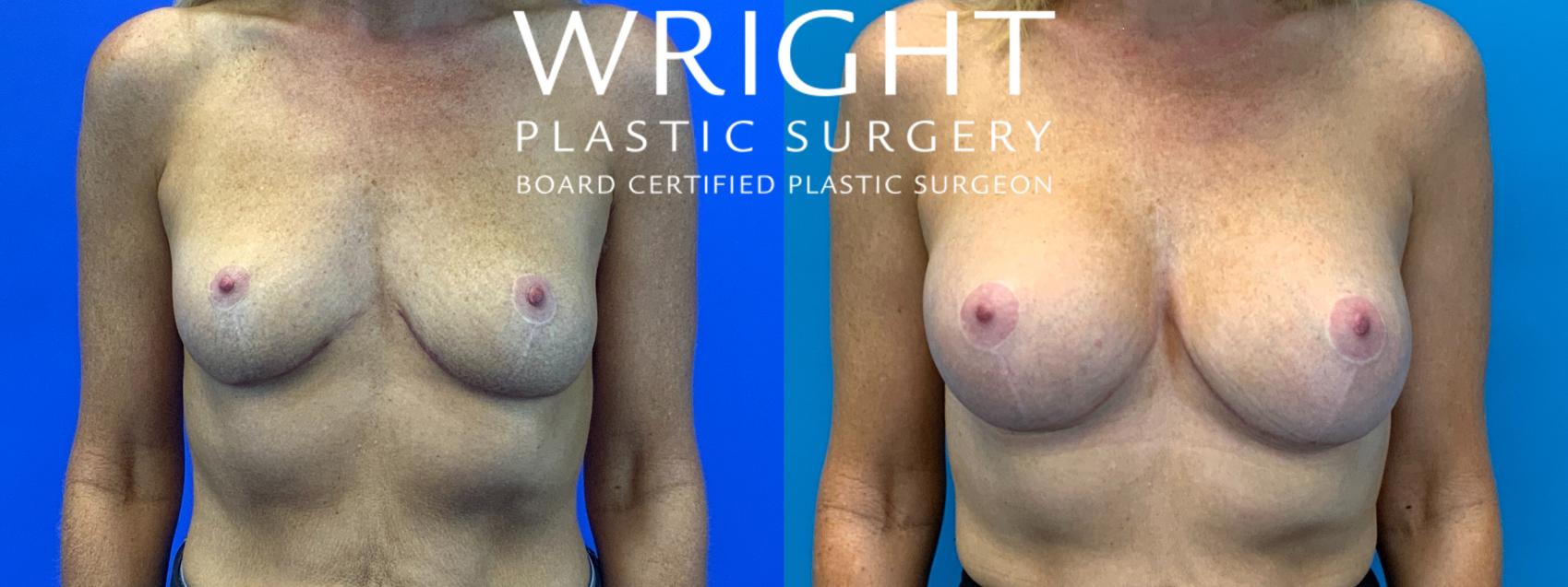Before & After Breast Augmentation Case 133 Front View in Little Rock, Arkansas