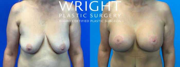 Before & After Breast Augmentation Case 136 Front View in Little Rock, Arkansas