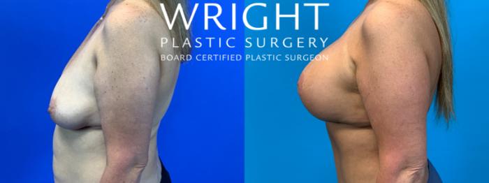 Before & After Breast Augmentation Case 136 Right Oblique View in Little Rock, Arkansas